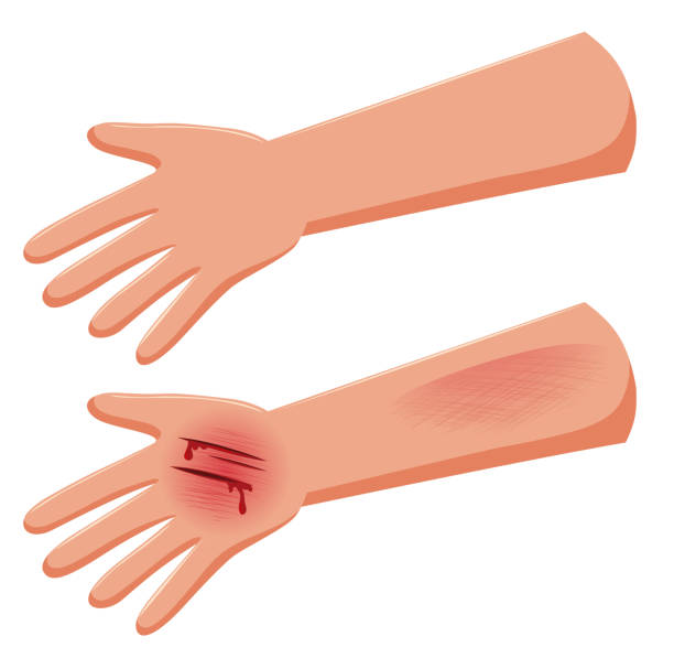 ilustrações de stock, clip art, desenhos animados e ícones de set of injure hand - wound blood human finger human hand