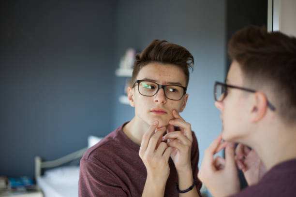 teenage boy popping pimples - urgency body care young adult people imagens e fotografias de stock