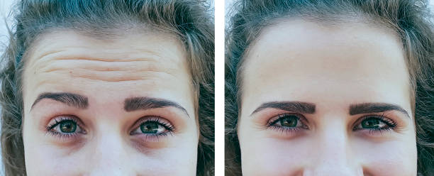 girl forehead wrinkles before and after procedures girl forehead wrinkles before and after procedures botox before and after stock pictures, royalty-free photos & images
