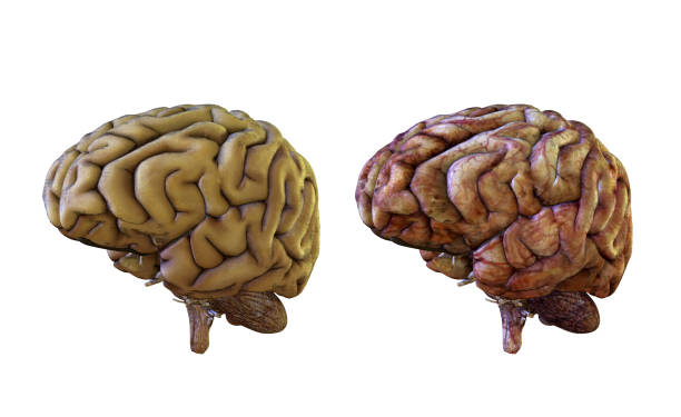 istock Human brain comparison healthy and inflamed, damaged 1136840633