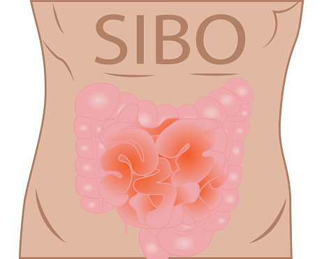 Small Intestinal Bacterial Overgrowth - SIBO. Vector illustration