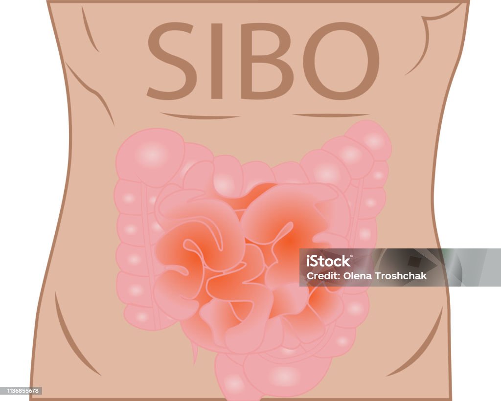 Intestinal Bacterial Small Intestinal Bacterial Overgrowth Sibo Stock Illustration ...