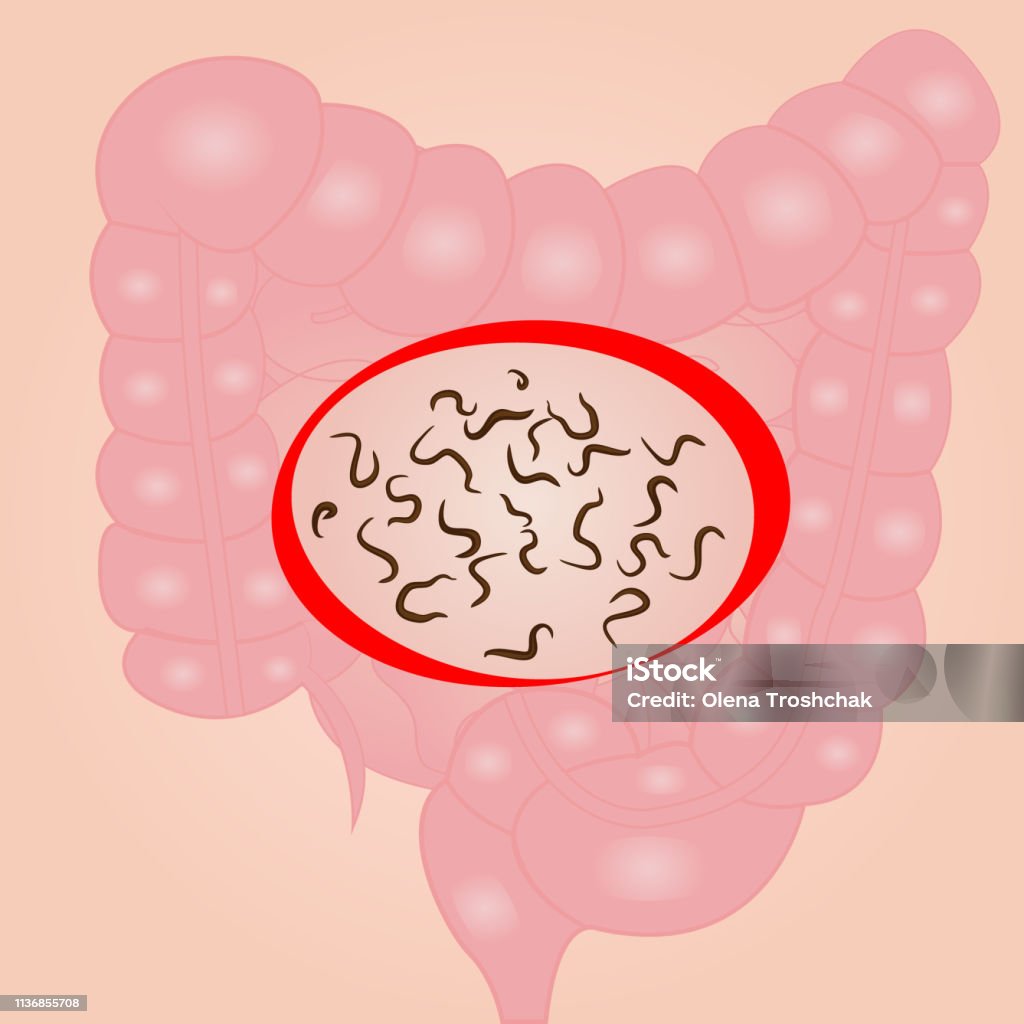 Roundworms Graphics Helminths In A Small Intestine Stock Illustration - Download Image Now ...