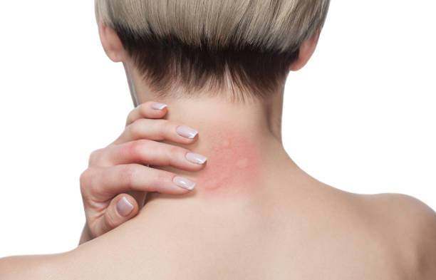 Girl with blond hair, sitting with his back turned and scratching bitten, red, swollen neck skin from mosquito bites in the summer in the forest. Girl with blond hair, sitting with his back turned and scratching bitten, red, swollen neck skin from mosquito bites in the summer in the forest. Close-up up of visible insect bites. Irritated skin. red wasp stock pictures, royalty-free photos & images