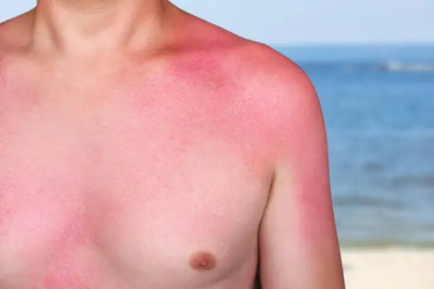 Photo of A man with reddened, itchy skin after sunburn. Skin care and protection from the sun's ultraviolet rays.