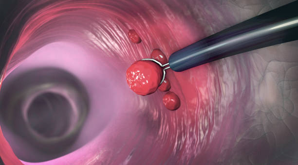 entfernung eines kolonpolypes mit einer elektrischen drahtschleife während einer koloskopie - 3d-illustration - biopsie stock-fotos und bilder