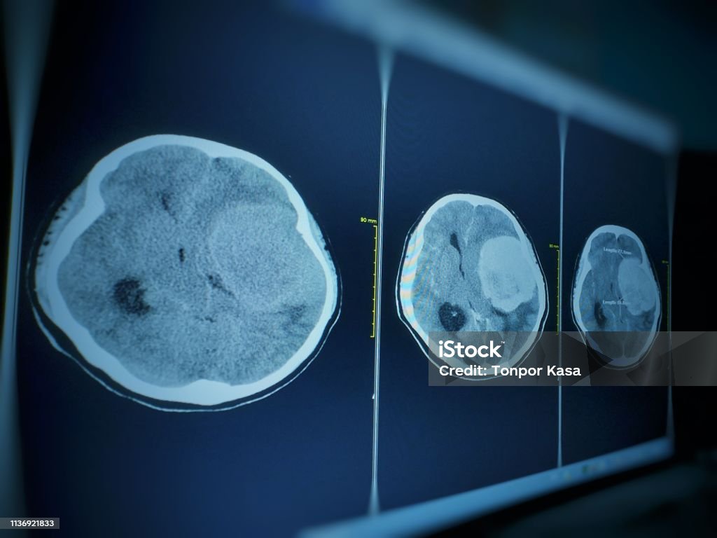 Ct Brain Ấn Tượng Một Khối Ngoại Trục Bảy Cm Với Tăng Cường Stong ...