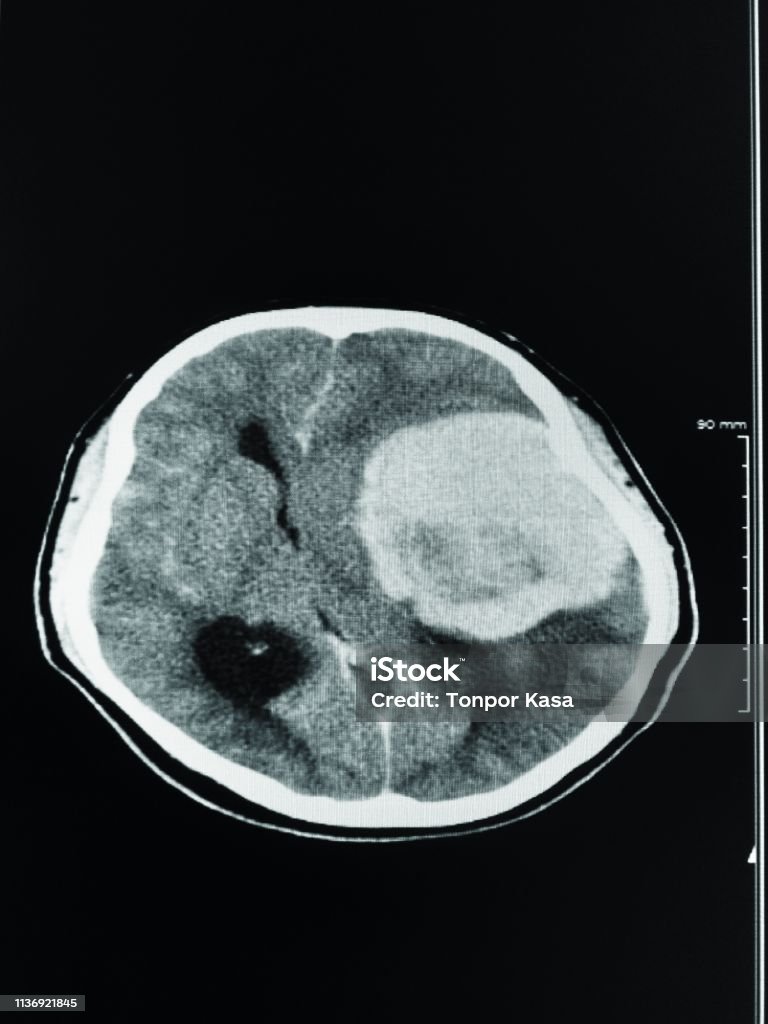 Ct Brain Ấn Tượng Một Khối Ngoại Trục Bảy Cm Với Tăng Cường Stong ...