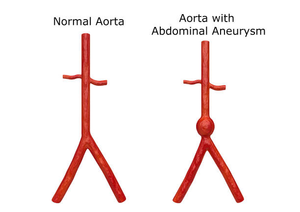 visione interna del corpo umano che dimostra un normale aorta e aneurisma aortico nella regione toracica e addominale. rendering 3d - aorta foto e immagini stock