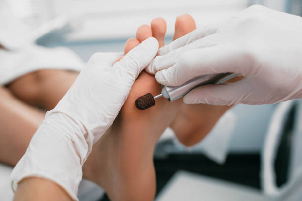 chiropodist removes hardened skin on the foot, using hardware. - podiatrist podiatry pedicure chiropodist imagens e fotografias de stock