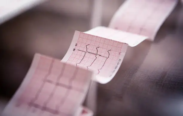 Medical cardiogram printed on paper on the table, disturbing news about the health of the heart