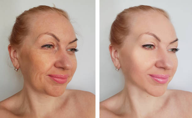 istock woman wrinkles before and after procedures 1137107209