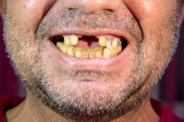 Toothless man, smiling man with yellowed teeth Close-up of toothless man laughing with yellowed teeth bad teeth stock pictures, royalty-free photos & images