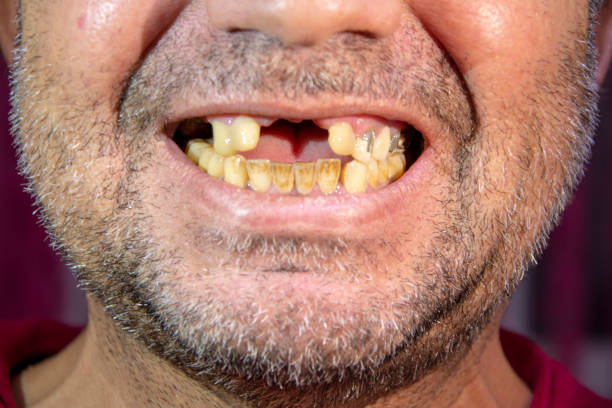 Toothless man, smiling man with yellowed teeth Close-up of toothless man laughing with yellowed teeth gap toothed stock pictures, royalty-free photos & images