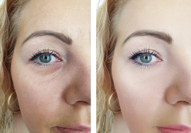 istock woman wrinkles before and after procedures 1137377129