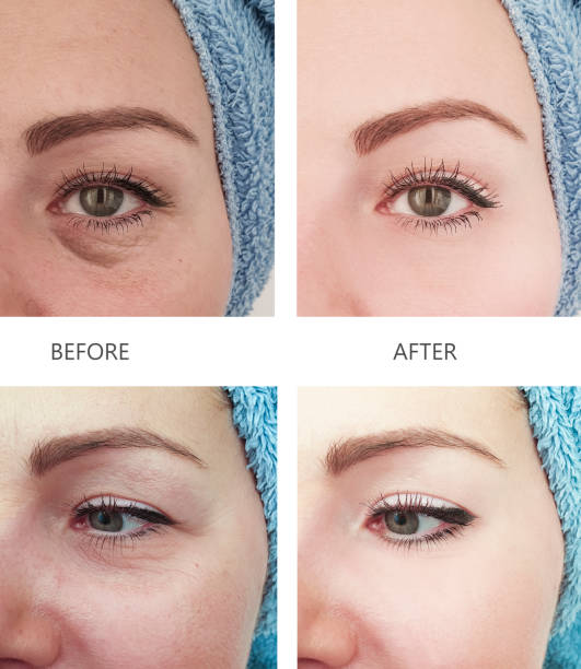 istock woman wrinkles before and after procedures 1137406033