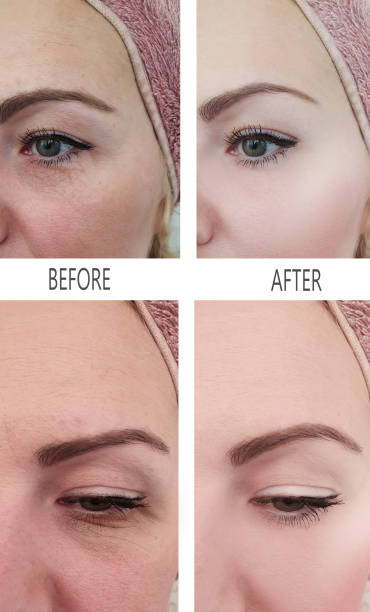 istock woman wrinkles before and after procedures 1137408391