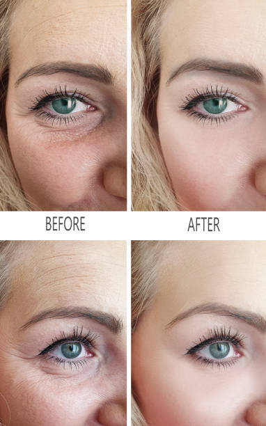 istock woman wrinkles before and after procedures 1137409590