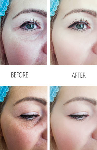 istock woman wrinkles before and after procedures 1137411510
