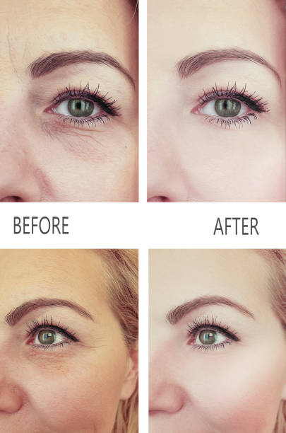 istock woman wrinkles before and after procedures 1137413140