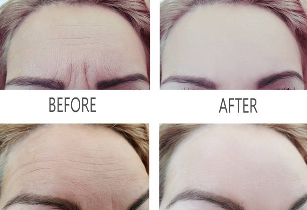 woman wrinkles before and after procedures woman wrinkles before and after procedures botox before and after stock pictures, royalty-free photos & images