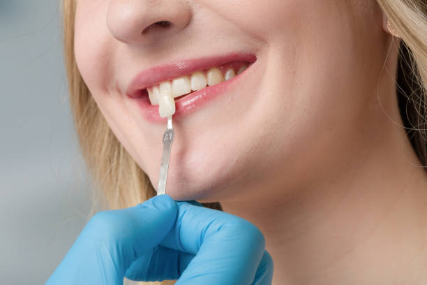 istock dentist using shade guide at woman's mouth to check veneer of tooth 1137510347