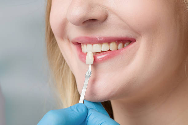 istock dentist using shade guide at woman's mouth to check veneer of tooth 1137510356