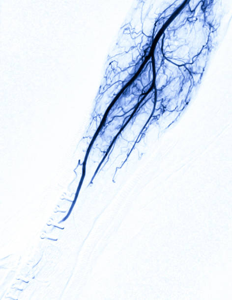 angiographie der brachialen arterie oder fluoroskopische bild von vessel in dem arm auf weißem hintergrund im interventionsradiologie-raum isoliert. - angio stock-fotos und bilder