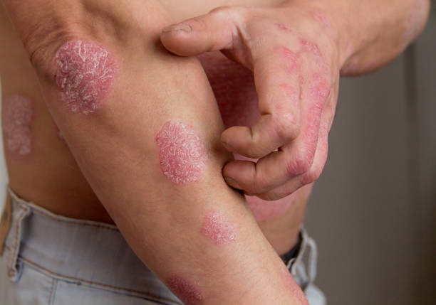 istock the man on the arm and abdomen psoriasis 1137585946