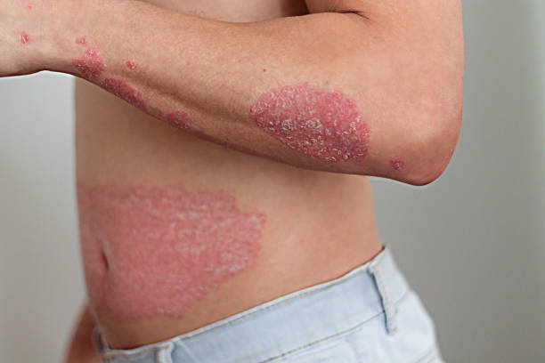 the man on the arm and abdomen psoriasis the man on the arm and abdomen spots psoriasis psoriasis stock pictures, royalty-free photos & images