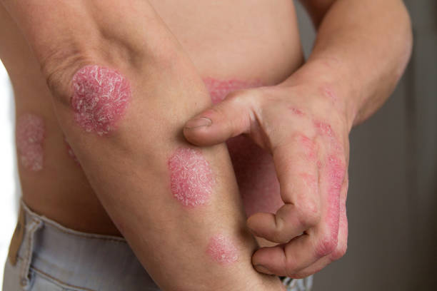 istock the man on the arm and abdomen psoriasis 1137585977