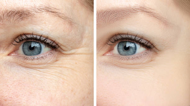 viso femminile, rughe degli occhi prima e dopo il trattamento - il risultato di procedure cosmetologiche ringiovanianti di biorivitalizzazione, rimozione di botox e macchie di pigmento - wrinkled foto e immagini stock