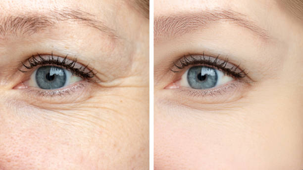 Woman face, eye wrinkles before and after treatment - the result of rejuvenating cosmetological procedures of biorevitalization, botox and pigment spots removal Woman face, eye wrinkles before and after treatment - the result of rejuvenating cosmetological procedures of biorevitalization, botox and pigment spots removal. crows feet surgery stock pictures, royalty-free photos & images