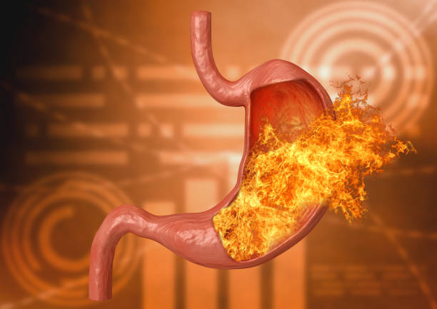 желудочный огонь. чрезмерная кислотность, несварение желудка, заболевания желудка, язва желудка, сильная боль в животе. 3d рендеринг - peptic ulcer стоковые фото и изображения