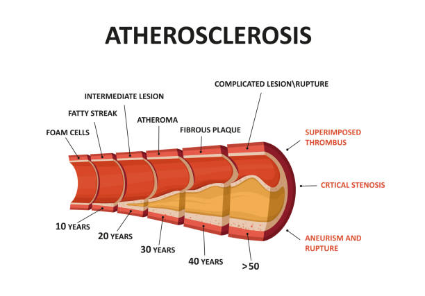 miażdżycy - cholesterol atherosclerosis human artery illness stock illustrations