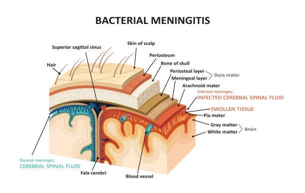 ilustrações, clipart, desenhos animados e ícones de meningite bacteriana - meningite
