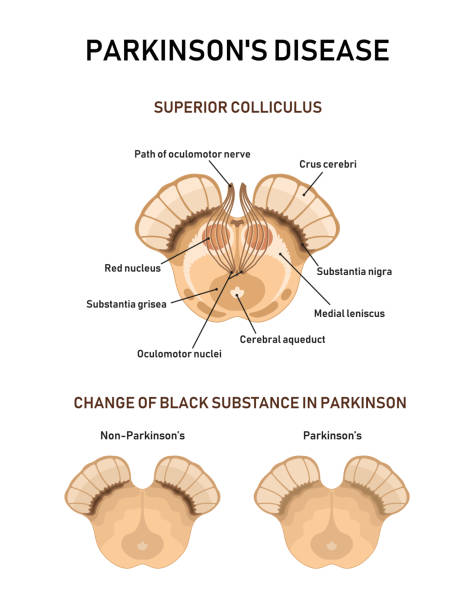 Midbrain anatomy. Parkinson's disease Midbrain anatomy. Parkinson's disease. Vector illustration midbrain illustrations stock illustrations