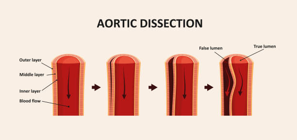 illustrazioni stock, clip art, cartoni animati e icone di tendenza di dissezione aortica, aneurisma aortico - aorta