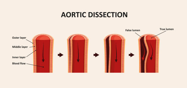 大動脈解離, 大動脈瘤 - dissection点のイラスト素材／クリップアート素材／マンガ素材／アイコン素材