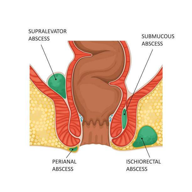 Anal abscess Anal abscess. Vector illustration anus stock illustrations