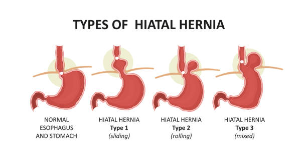 types of hiatal hernia types of hiatal hernia. Vector illustration sphincter stock illustrations