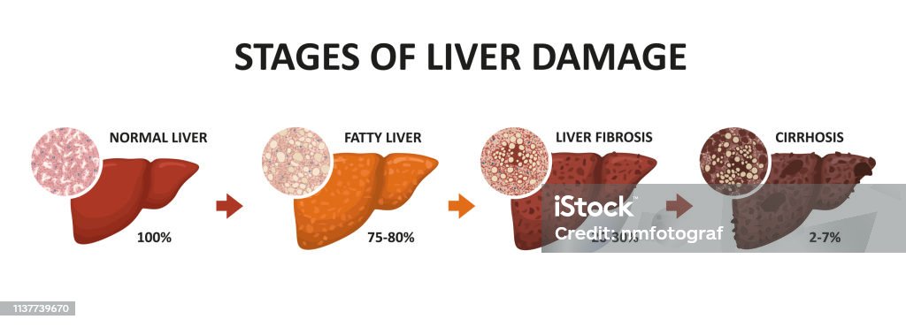 Stages of liver damage. Healthy, fatty, liver fibrosis and cirrhosis. Stages of liver damage. Healthy, fatty, liver fibrosis and cirrhosis. Vector illustration Liver - Organ stock vector
