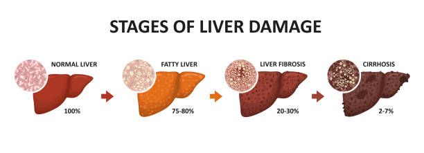 Stages of liver damage. Healthy, fatty, liver fibrosis and cirrhosis. Stages of liver damage. Healthy, fatty, liver fibrosis and cirrhosis. Vector illustration cirrhosis stock illustrations