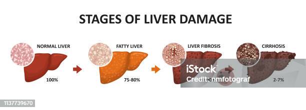 Stages Of Liver Damage Healthy Fatty Liver Fibrosis And Cirrhosis Stock Illustration - Download Image Now