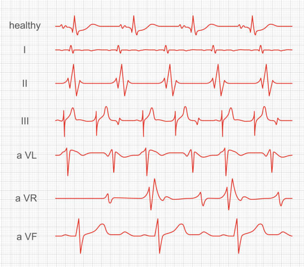 illustrations, cliparts, dessins animés et icônes de cardiogramme, rythme cardiaque rouge sur l'écran du moniteur - rythme cardiaque