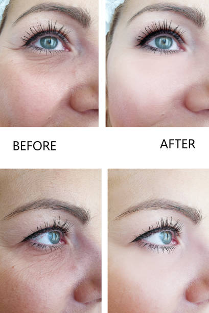istock woman wrinkles before and after the procedure 1137820191
