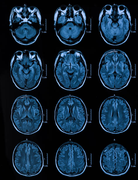 tomografia de cabeça humana de ressonância magnética - mri scan human nervous system brain medical scan - fotografias e filmes do acervo