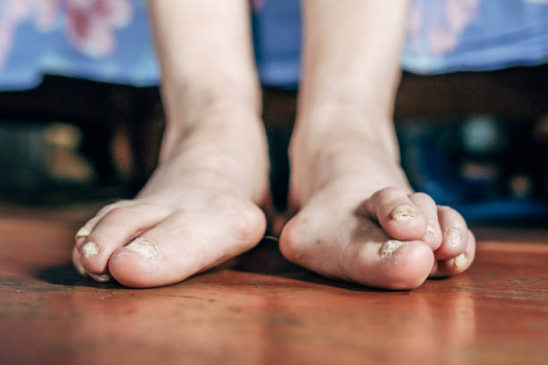 木製の茶色の床に腱膜瘤 (母趾外反) 問題を抱えている裸足。足に大きなつま先をつなぐ関節の変形 - misalignment ストックフォトと画像
