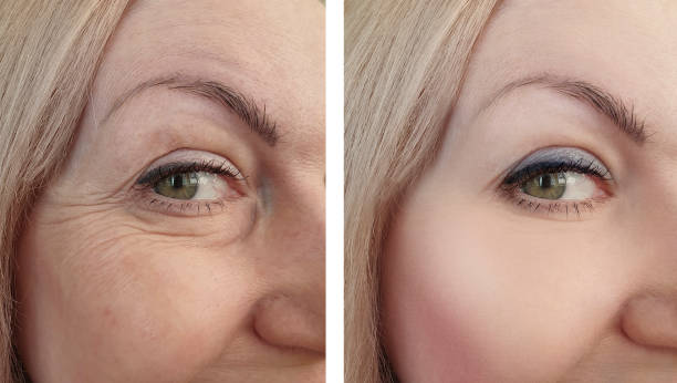 woman eye wrinkles before and after procedures woman eye wrinkles before and after procedures botox before and after stock pictures, royalty-free photos & images