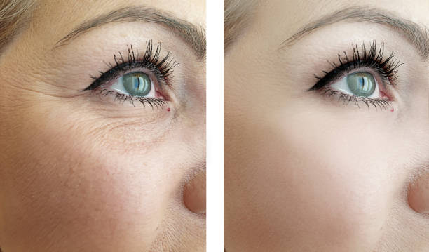 donna rughe degli occhi prima e dopo le procedure - wrinkled foto e immagini stock